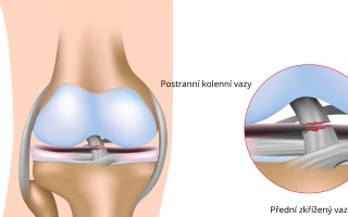 Přetržení předního zkříženého vazu