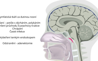 Odstranění nosních mandlí - Adenotomie