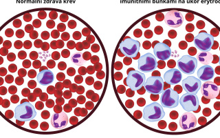 Rozdíl mezi leukémií akutní a chronickou